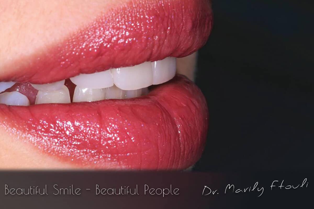 Beautiful Smile - Beautiful People | drftouli.gr